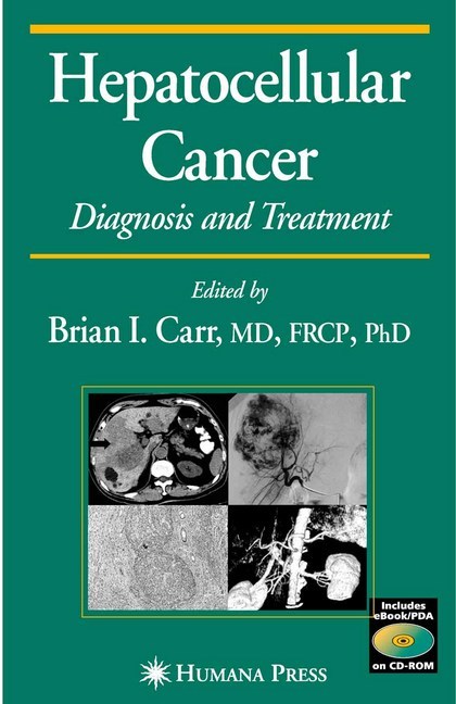Hepatocellular Carcinoma main product photo