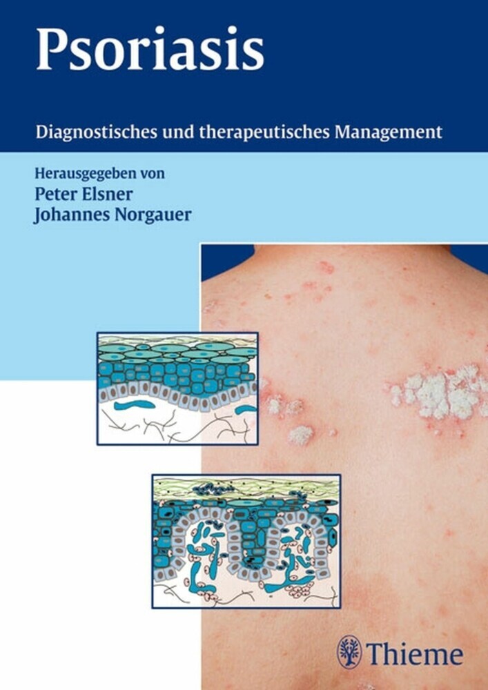 Psoriasis main product photo