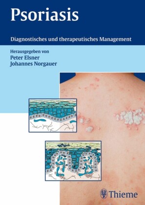 Psoriasis