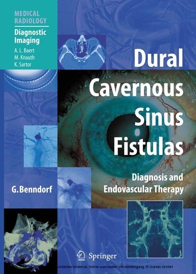 Dural Cavernous Sinus Fistulas main product photo