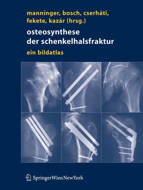 Osteosynthese der Schenkelhalsfraktur main product photo