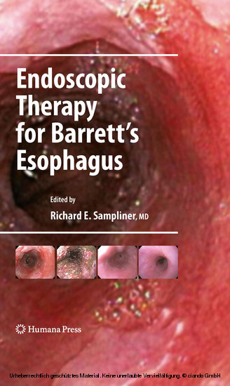 Endoscopic Therapy for Barrett's Esophagus main product photo