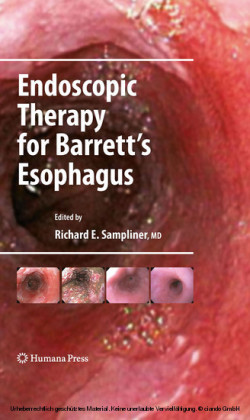 Endoscopic Therapy for Barrett's Esophagus