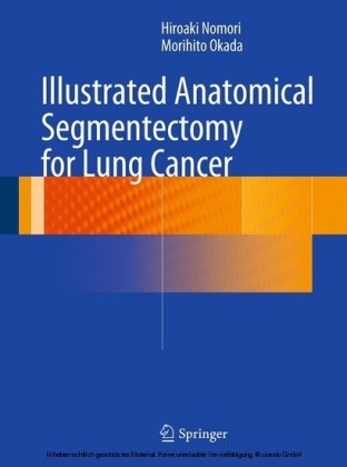 Illustrated Anatomical Segmentectomy for Lung Cancer