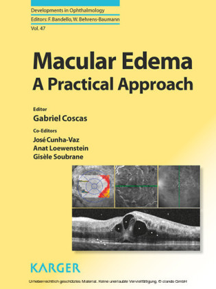 Macular Edema