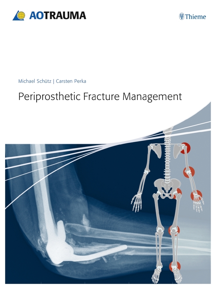 Periprosthetic Fracture Management main product photo