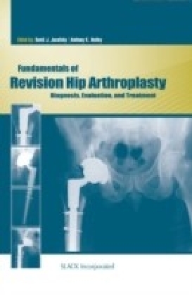 Fundamentals of Revision Hip Arthroplasty