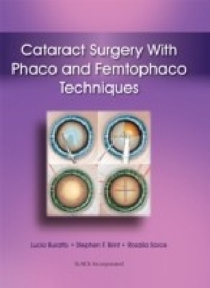 Cataract Surgery With Phaco and Femtophaco Techniques