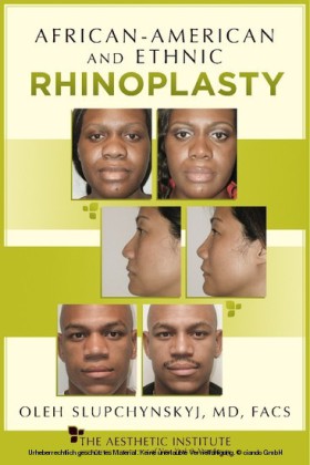 African-American and Ethnic Rhinoplasty