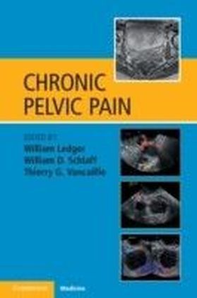 Chronic Pelvic Pain