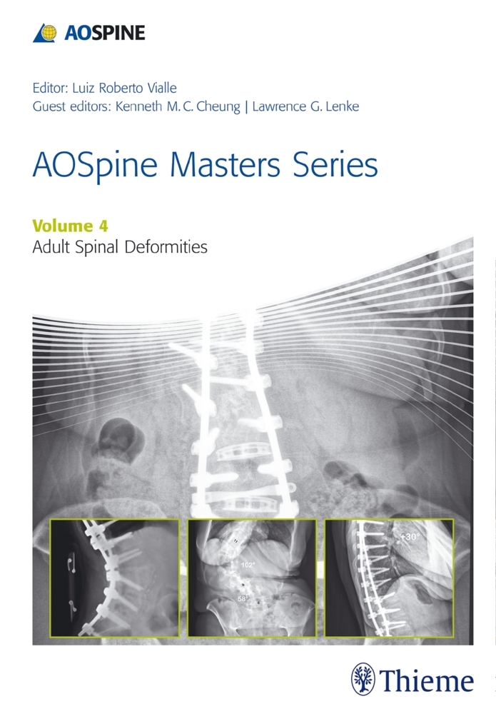 AOSpine Master Series - Adult Spinal Deformities main product photo
