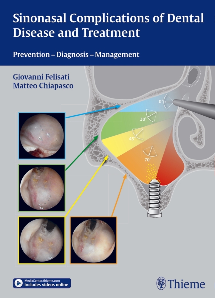 Sinonasal Complications of Dental Disease and Treatment main product photo