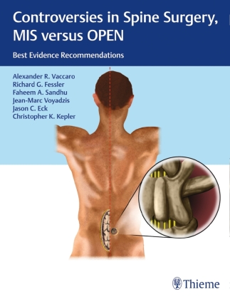 Controversies in Spine Surgery: MIS versus OPEN