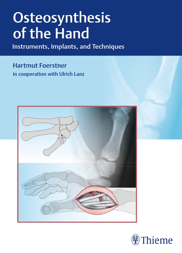 Osteosynthesis of the Hand main product photo