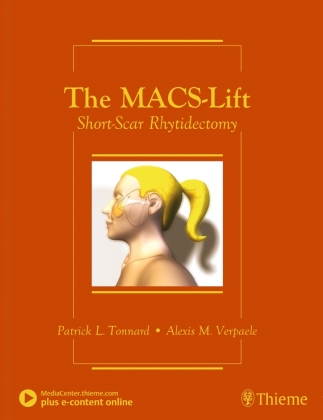 The MACS-Lift