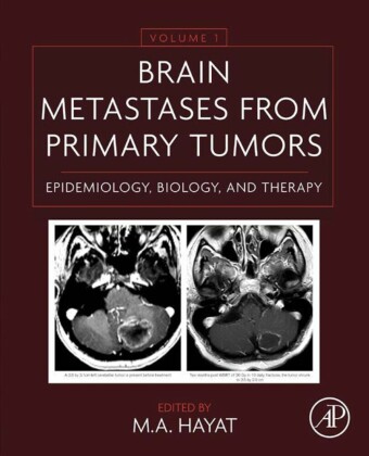 Brain Metastases from Primary Tumors Volume 1