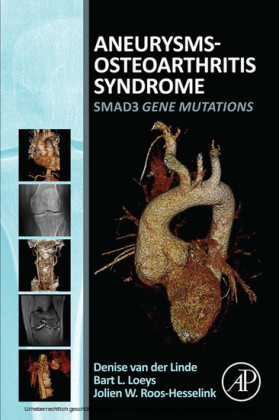 Aneurysms-Osteoarthritis Syndrome