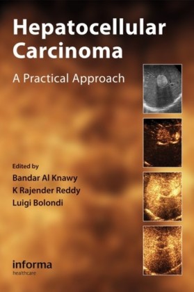 Hepatocellular Carcinoma