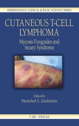Cutaneous T-Cell Lymphoma