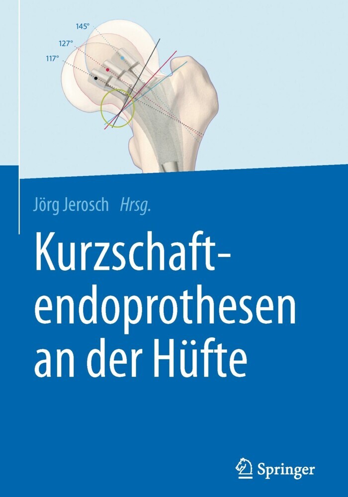 Kurzschaftendoprothesen an der Hüfte main product photo