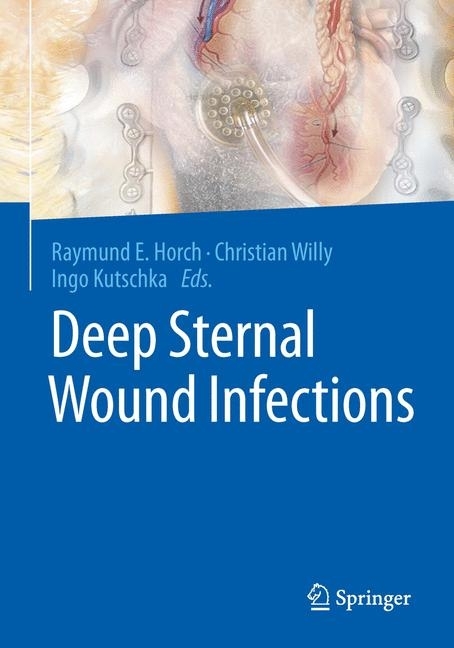 Deep Sternal Wound Infections main product photo