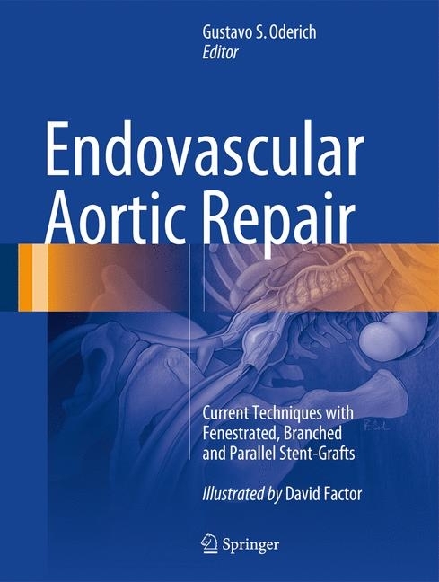 Endovascular Aortic Repair main product photo
