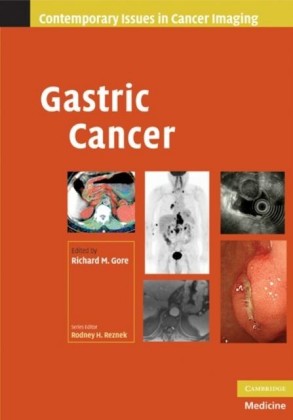 Gastric Cancer