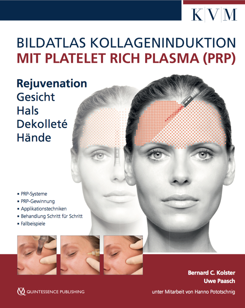 Bildatlas Kollageninduktion mit Platelet Rich Plasma (PRP) main product photo