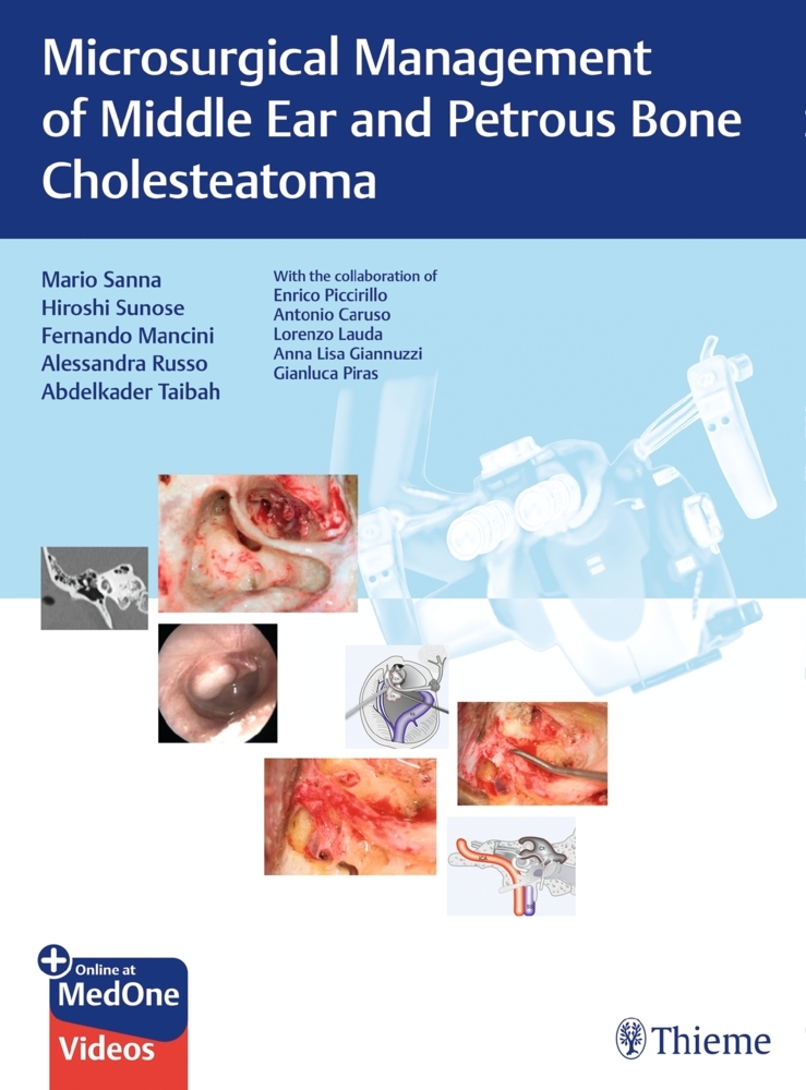 Microsurgical Management of Middle Ear and Petrous Bone Cholesteatoma main product photo