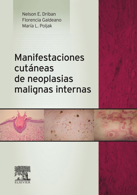 Manifestaciones cutáneas de neoplasias malignas internas main product photo