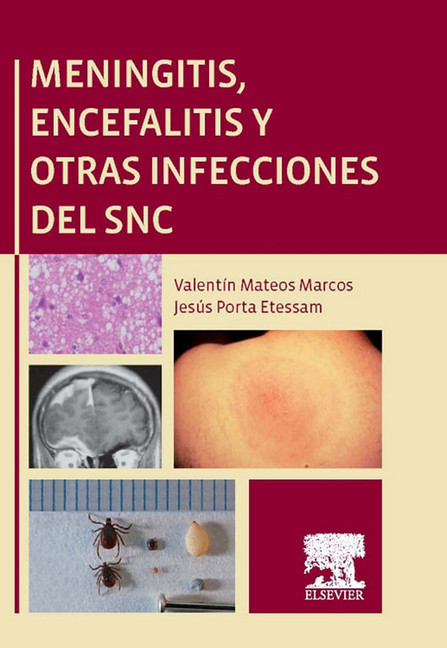 Meningitis, encefalitis y otras infecciones del SNC main product photo