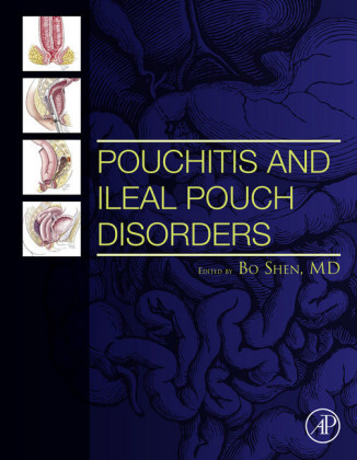 Pouchitis and Ileal Pouch Disorders