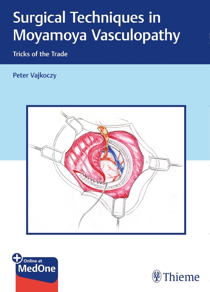 Surgical Techniques in Moyamoya Vasculopathy main product photo