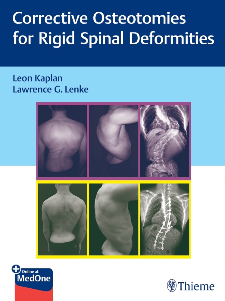Corrective Osteotomies for Rigid Spinal Deformities main product photo
