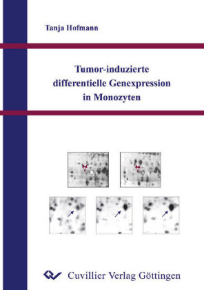 Tumor-induzierte differentielle Genexpression in Monozyten