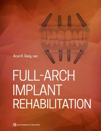 Full-Arch Implant Rehabilitation