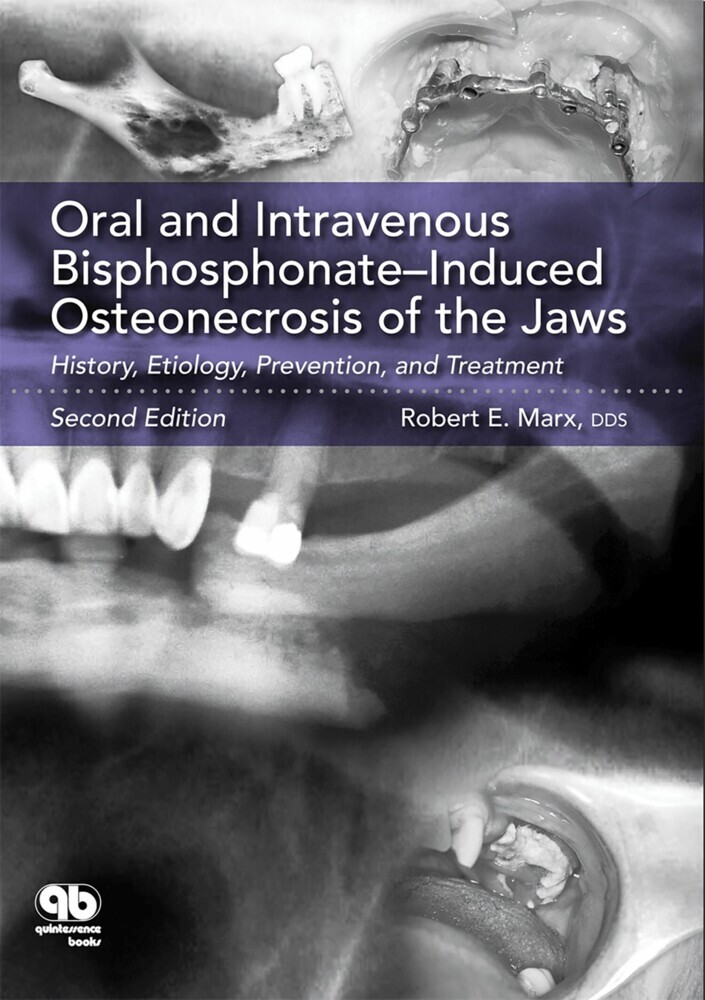 Oral and Intravenous Bisphosphonate-Induced Osteonecrosis of the Jaws main product photo