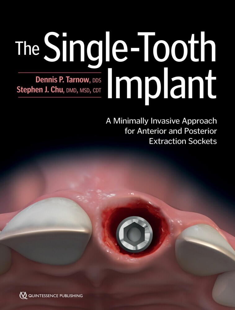The Single-Tooth Implant: main product photo