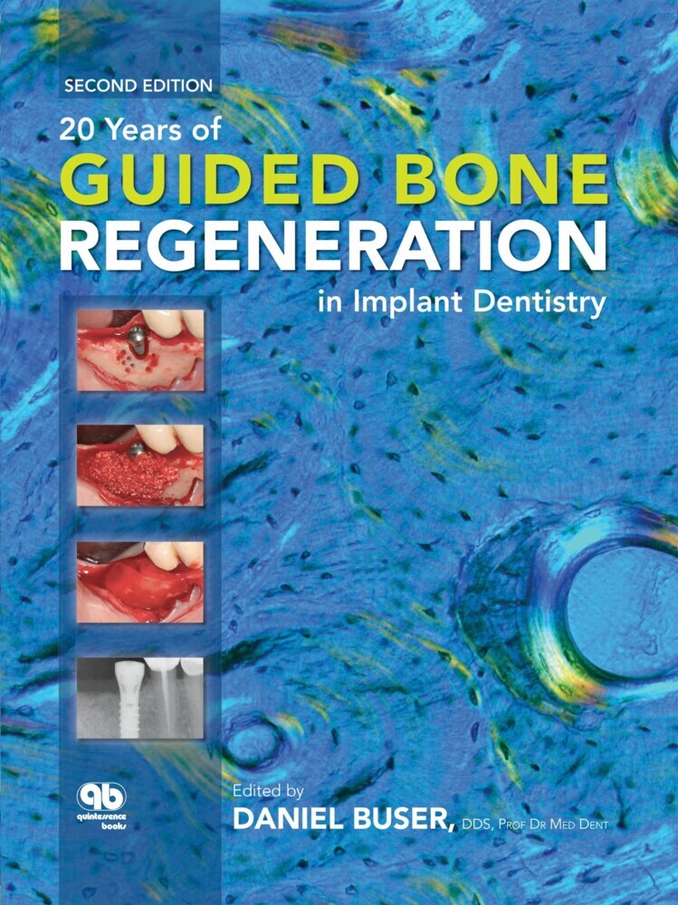 20 Years of Guided Bone Regeneration in Implant Dentistry main product photo