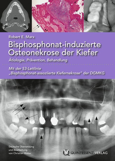 Bisphosphonat-induzierte Osteonekrose der Kiefer main product photo