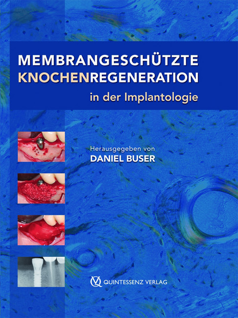 Membrangeschützte Knochenregeneration in der Implantologie main product photo
