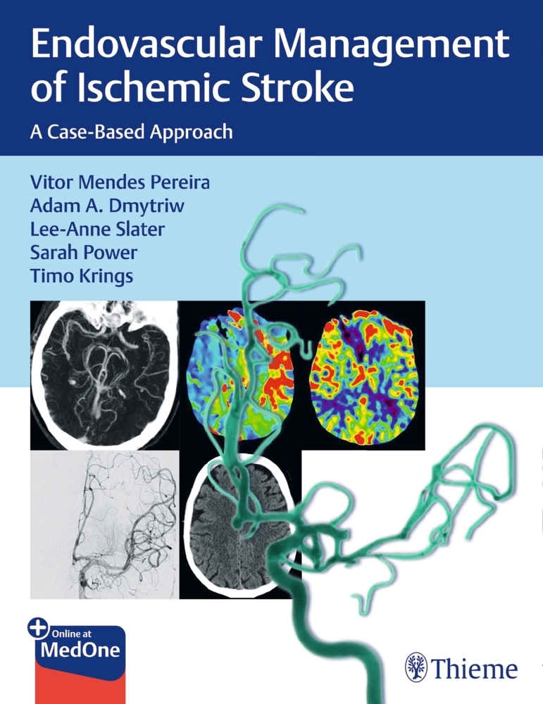 Endovascular Management of Ischemic Stroke main product photo