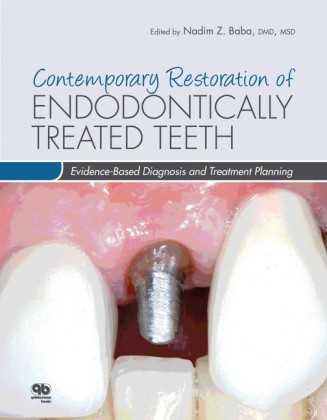 Contemporary Restoration of Endodontically Treated Teeth; .