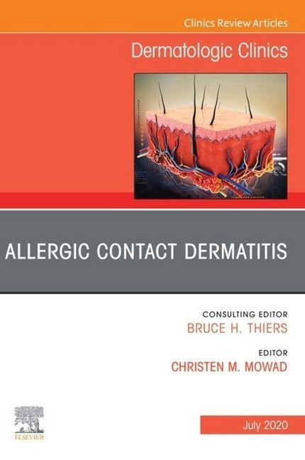Allergic Contact Dermatitis,An Issue of Dermatologic Clinics - E-Book main product photo