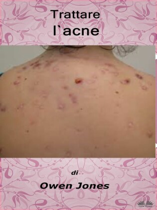 Trattare L'Acne
