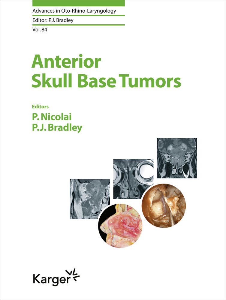 Anterior Skull Base Tumors main product photo