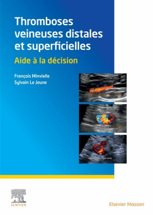 Thromboses veineuses distales et superficielles