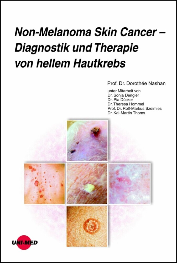 Non-Melanoma Skin Cancer - Diagnostik und Therapie von hellem Hautkrebs main product photo