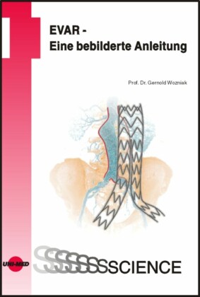 EVAR - Eine bebilderte Anleitung