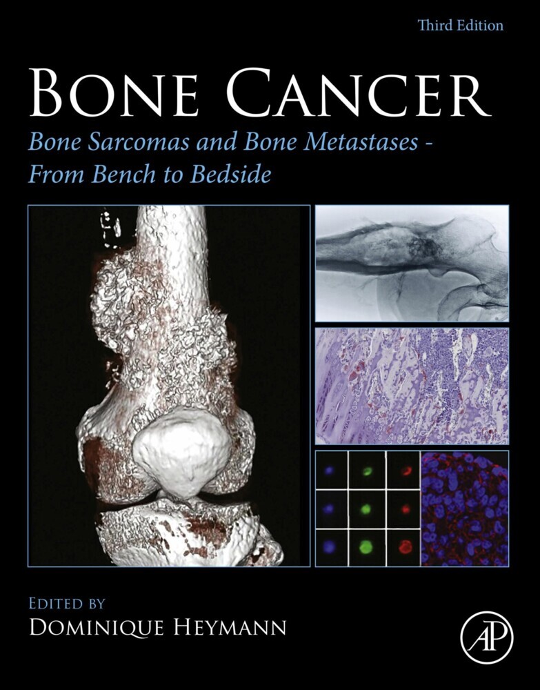Bone Cancer main product photo